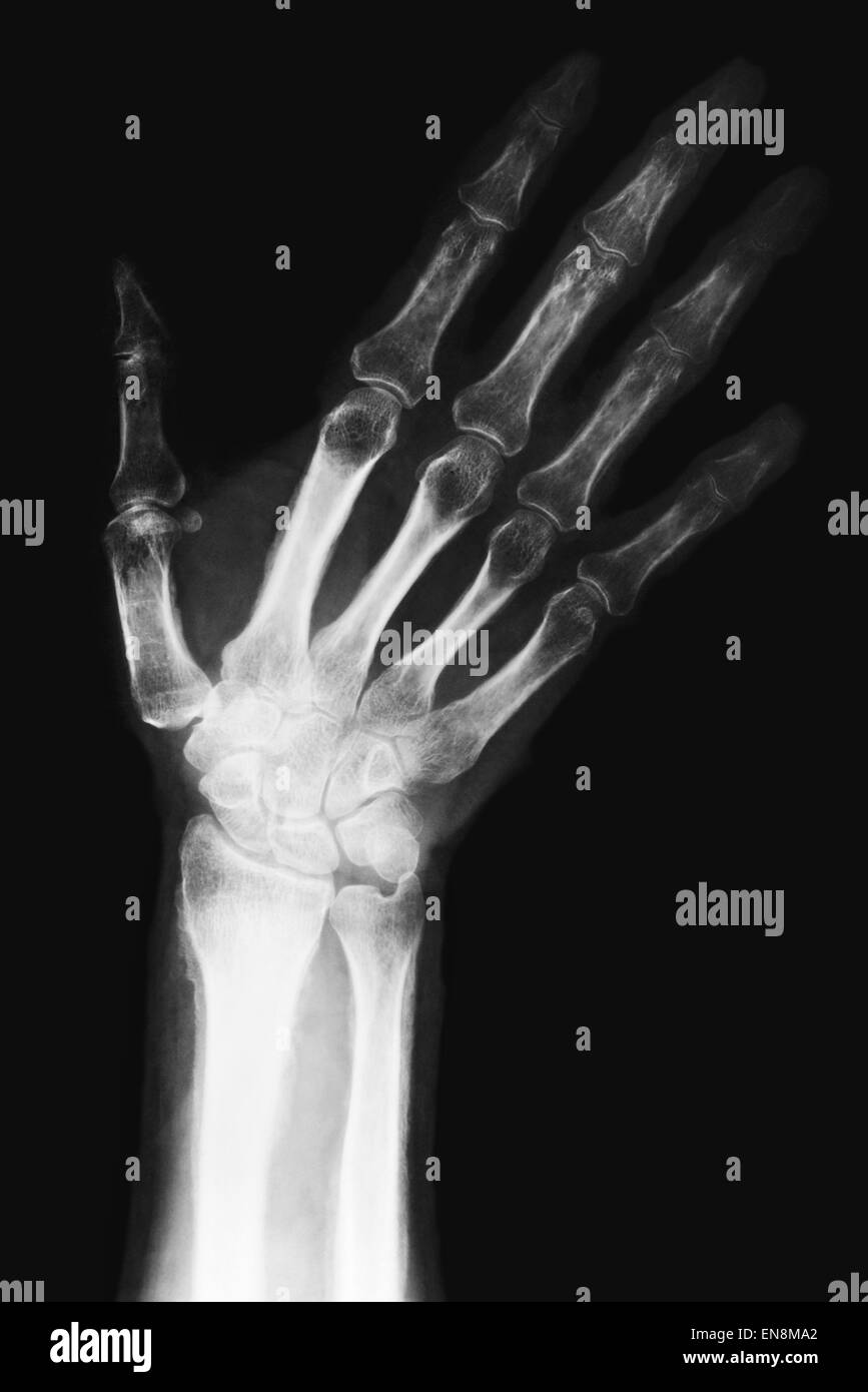 Xray attraverso adulto mano e polso con radio e ulna ossa trattamento diagnostico dita pollice Foto Stock