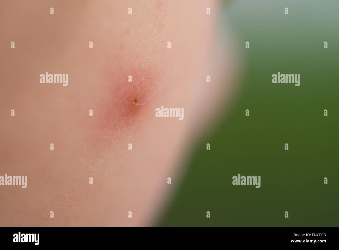 Un'immagine ravvicinata di un morso di zanzara su un ragazzo guancia Foto Stock