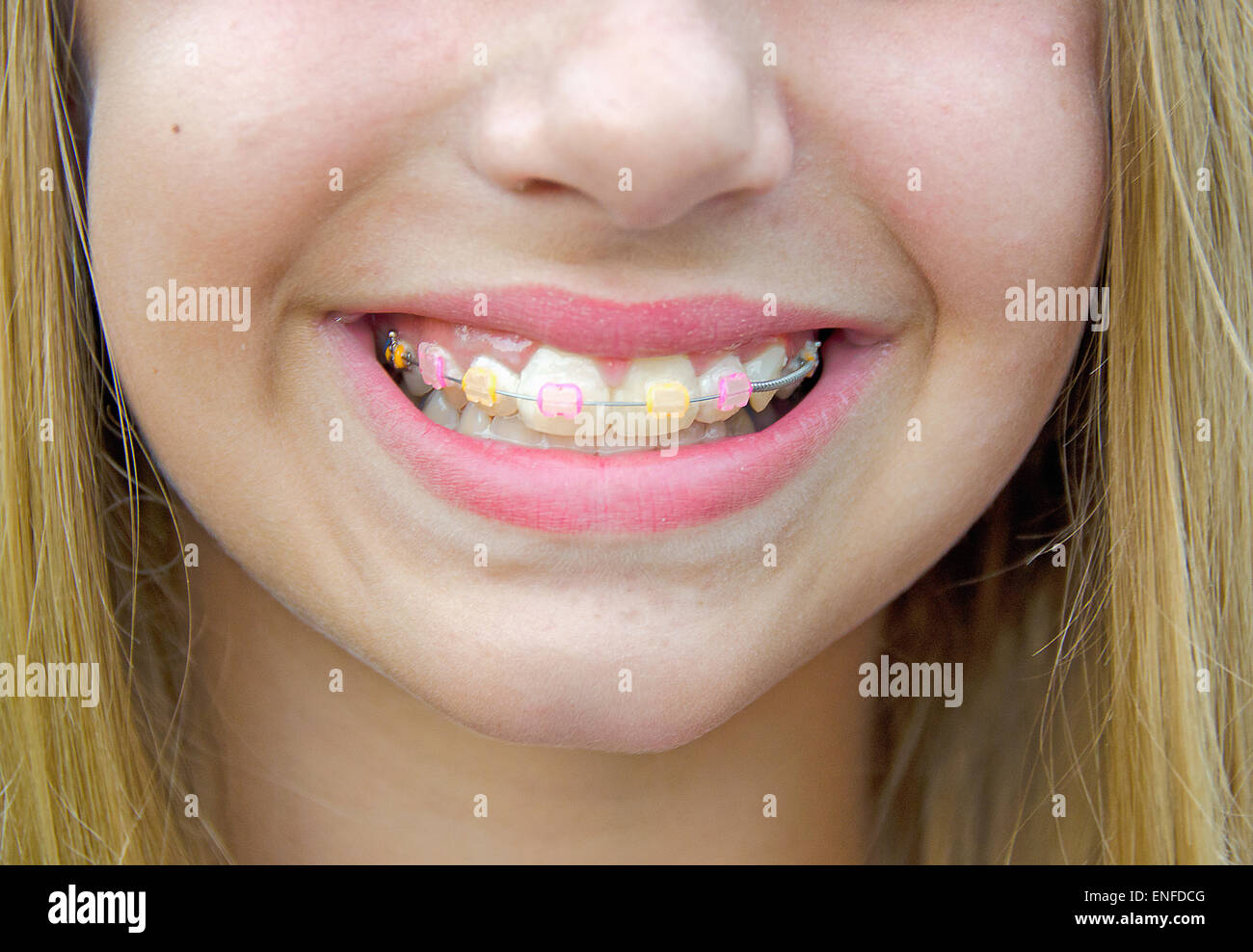 Ragazza giovane con bretelle ortodontico su i suoi denti. Foto Stock