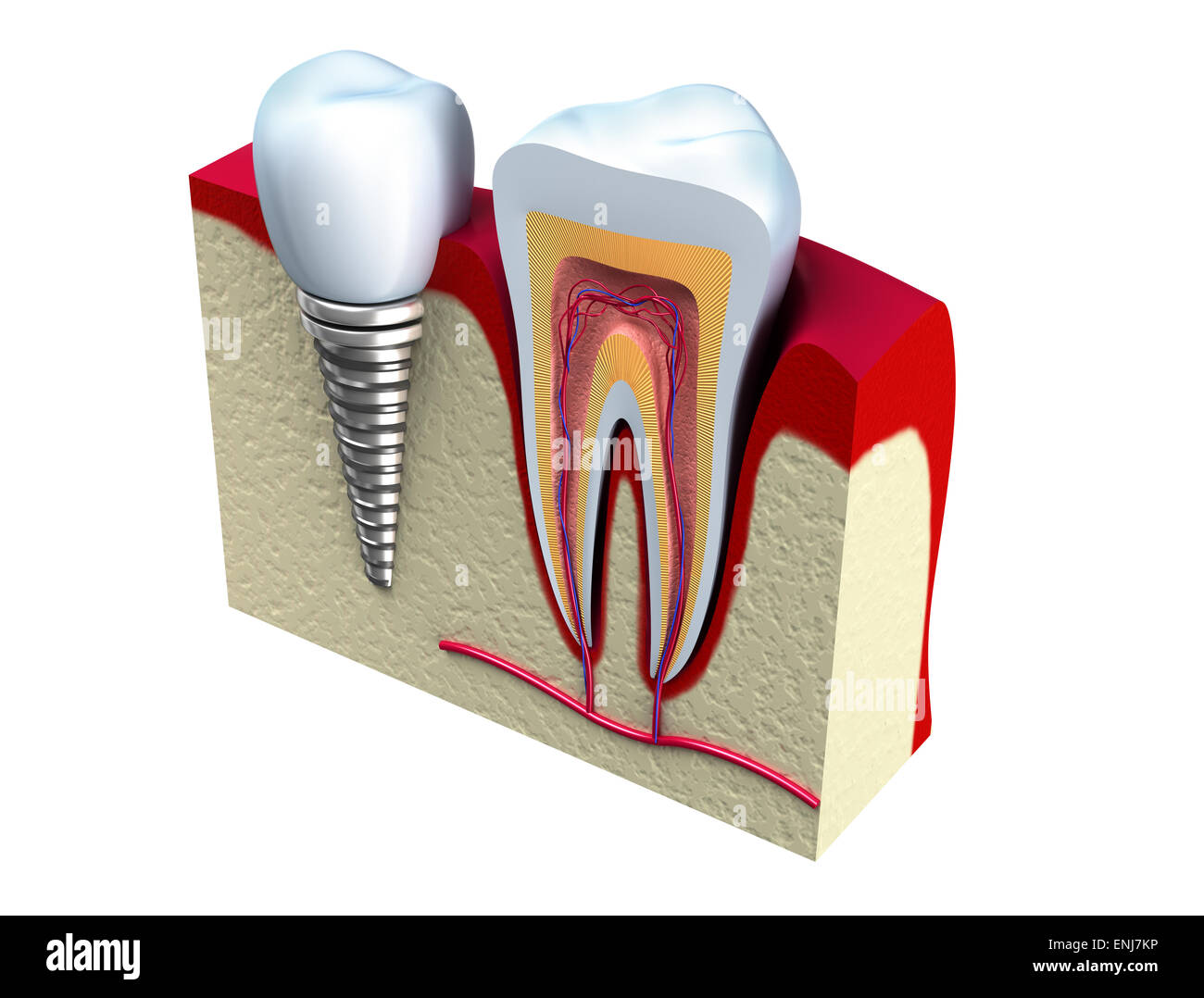 Anatomia di denti sani e impianto dentale in osso mandibolare. Foto Stock