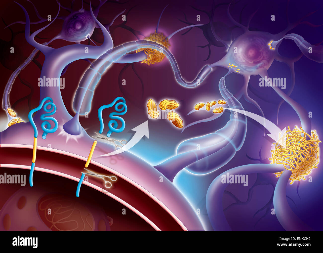 Il morbo di Alzheimer, disegno Foto Stock
