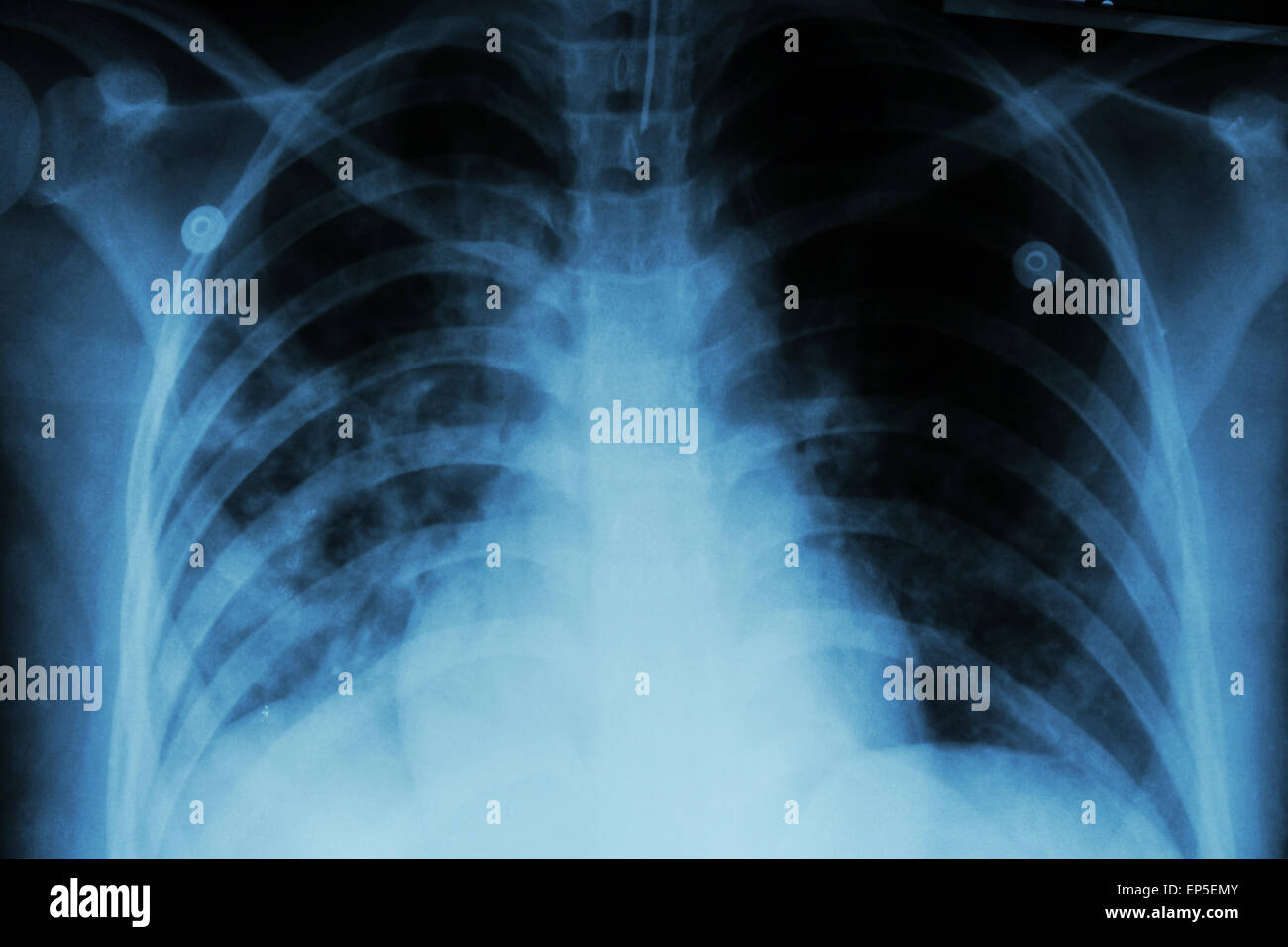 La tubercolosi polmonare ( TB ) : i raggi x al torace mostra infiltrazione alveolare in corrispondenza di entrambi i polmoni a causa di mycobacterium tuberculosis infectio Foto Stock