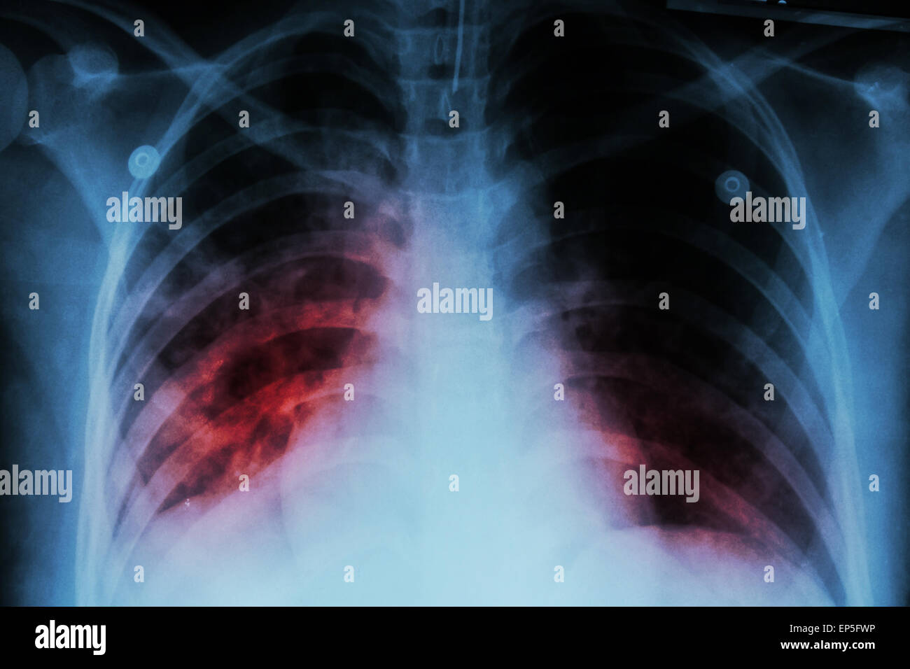 La tubercolosi polmonare ( TB ) : i raggi x al torace mostra infiltrazione alveolare in corrispondenza di entrambi i polmoni a causa di mycobacterium tuberculosis infectio Foto Stock