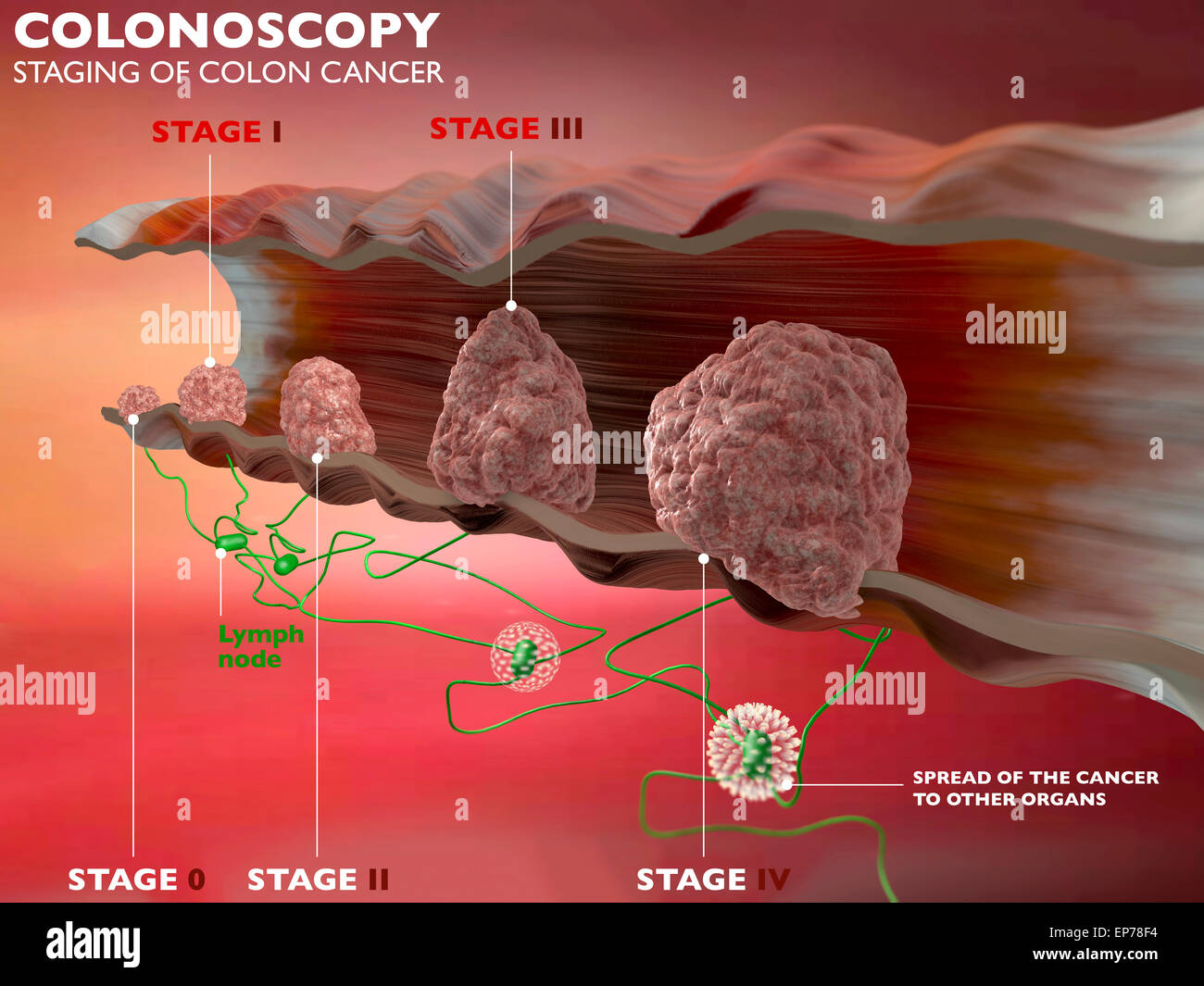 Fasi di cancro al colon su sfondo rosso Foto Stock