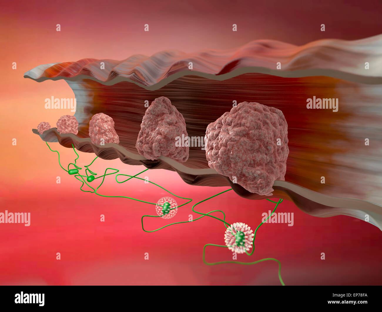 Fasi di cancro al colon su sfondo rosso Foto Stock