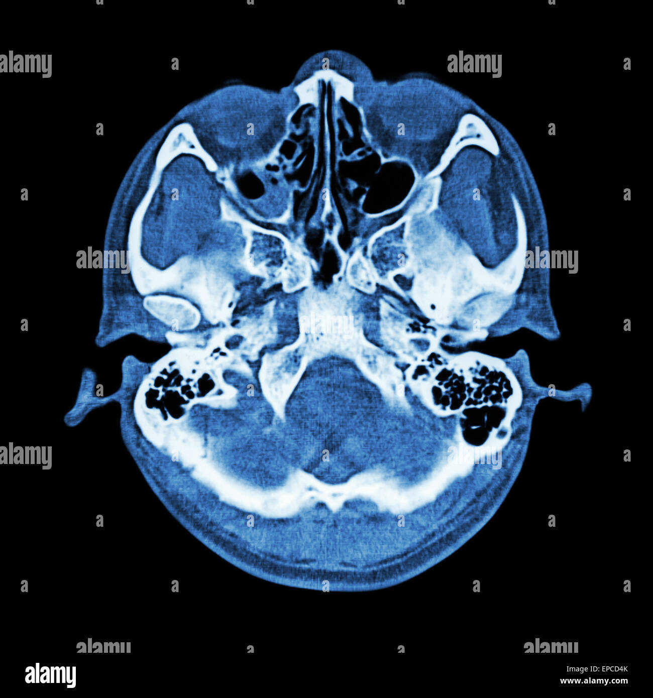 Scansione TC del cervello e la base del cranio ( finestra ossea ) Foto Stock