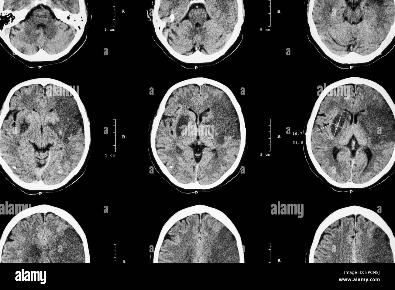 Ictus ischemico : ( CT del cervello mostrano l'infarto cerebrale a sinistro frontale - temporale - lobo parietale ) ( sistema nervoso backgroun Foto Stock