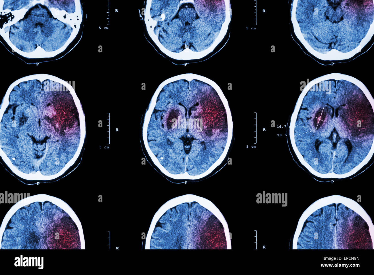 Ictus ischemico : ( CT del cervello mostrano l'infarto cerebrale a sinistro frontale - temporale - lobo parietale ) ( sistema nervoso backgroun Foto Stock