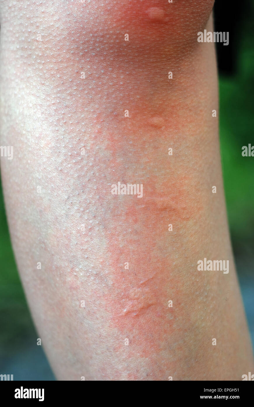 Puntura di zanzara immagini e fotografie stock ad alta risoluzione - Alamy