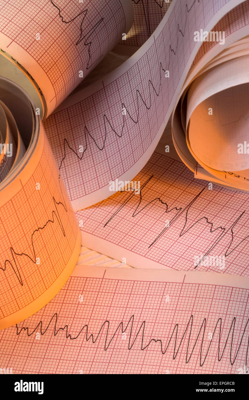 Elettrocardiografo tracce di aritmia cardiaca compresa fibrillazione ventricolare e la tachicardia ventricolare (VT). Foto Stock