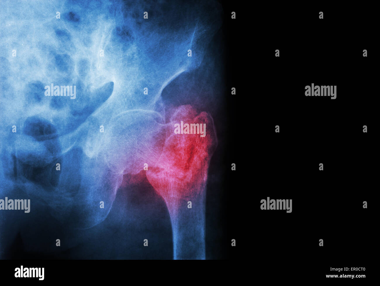 Fratture intertrocanteriche ( collo del femore ) frattura femore sinistro ( thigh bone ) e la zona vuota a destra Foto Stock