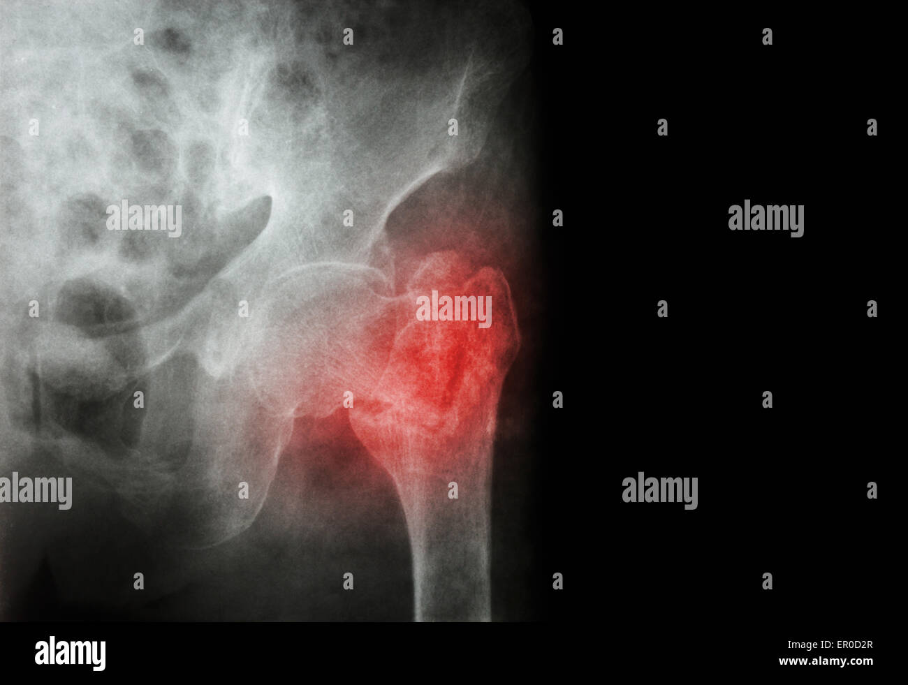 Fratture intertrocanteriche ( collo del femore ) frattura femore sinistro ( thigh bone ) e la zona vuota a destra Foto Stock