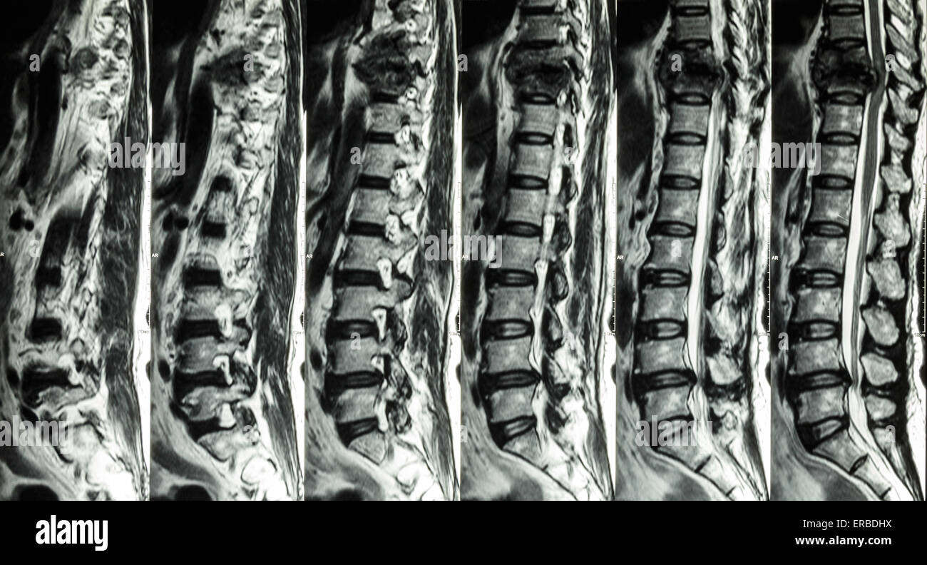 Di MRI e lombare della colonna vertebrale toracica : mostra la frattura della colonna vertebrale toracica e comprimere il midollo spinale Myelopathy ( ) Foto Stock