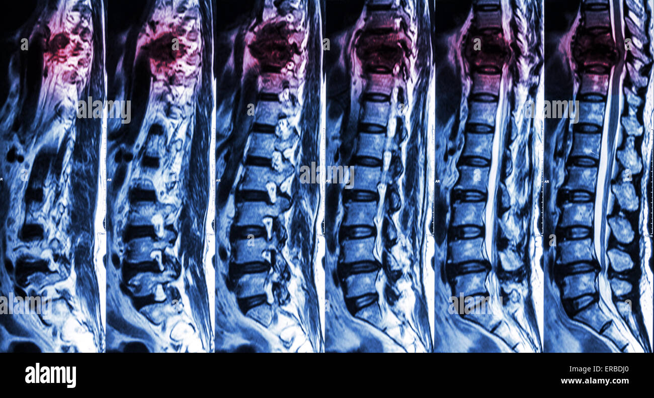 Di MRI e lombare della colonna vertebrale toracica : mostra la frattura della colonna vertebrale toracica e comprimere il midollo spinale Myelopathy ( ) Foto Stock