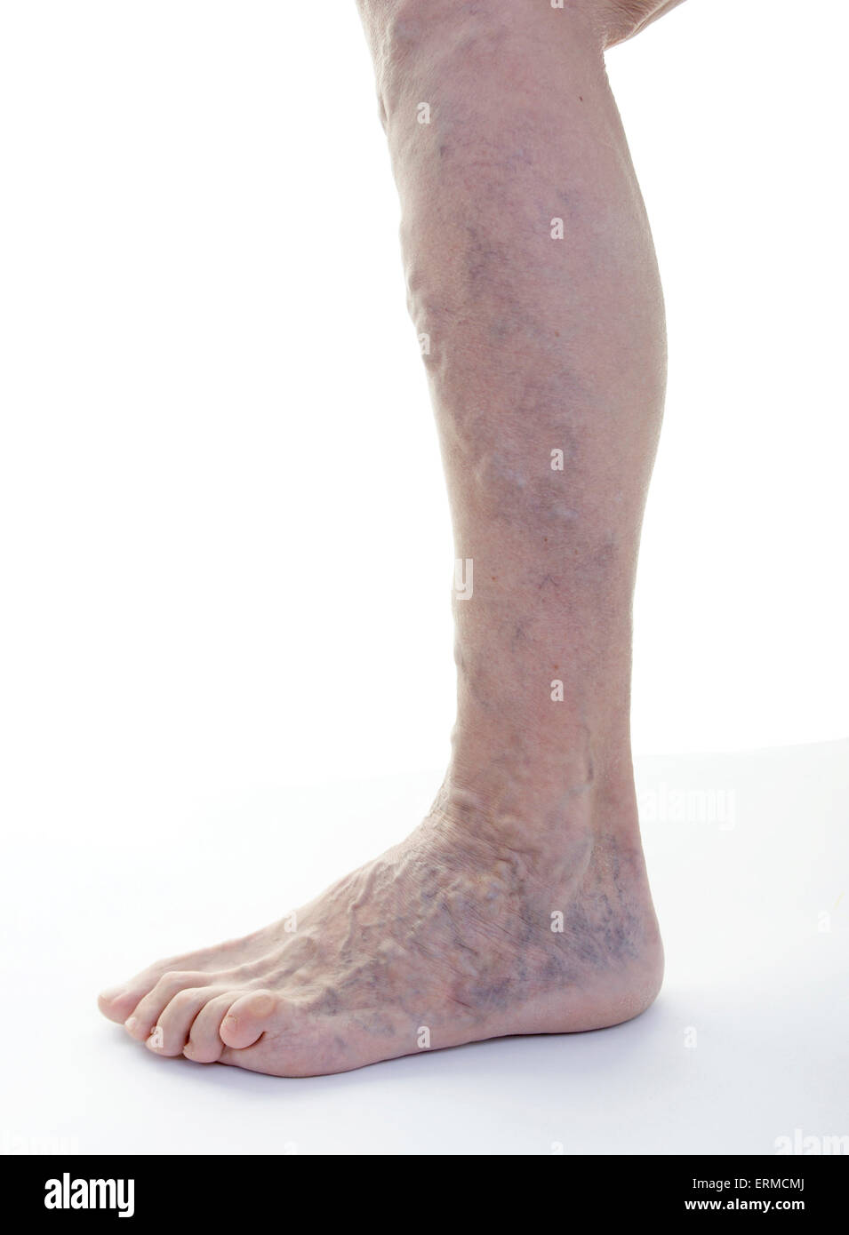 Vene varicose gamba (femmine, età 68 anni) / Krampfadern Varizen am Bein (Frau, Alter 68 Jahre) Foto Stock