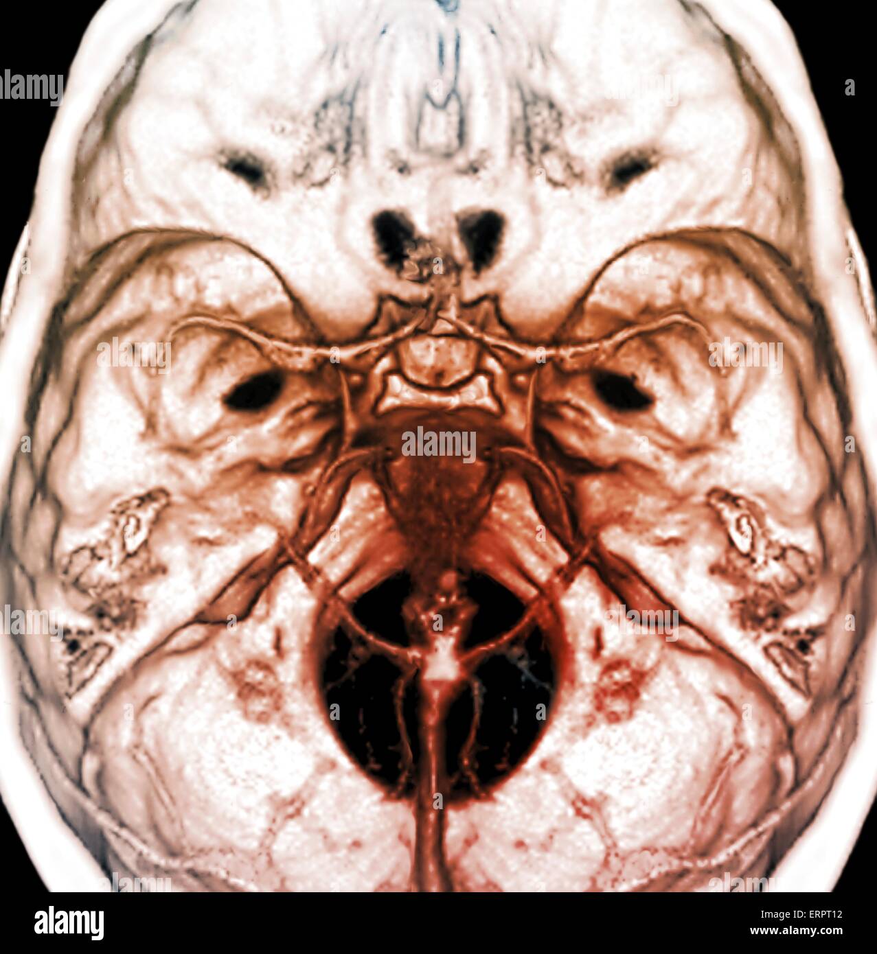 Le arterie del cervello. 3D la tomografia computerizzata (CT) scansione angio di arterie normale nel cervello di un 38 anno di età. Foto Stock