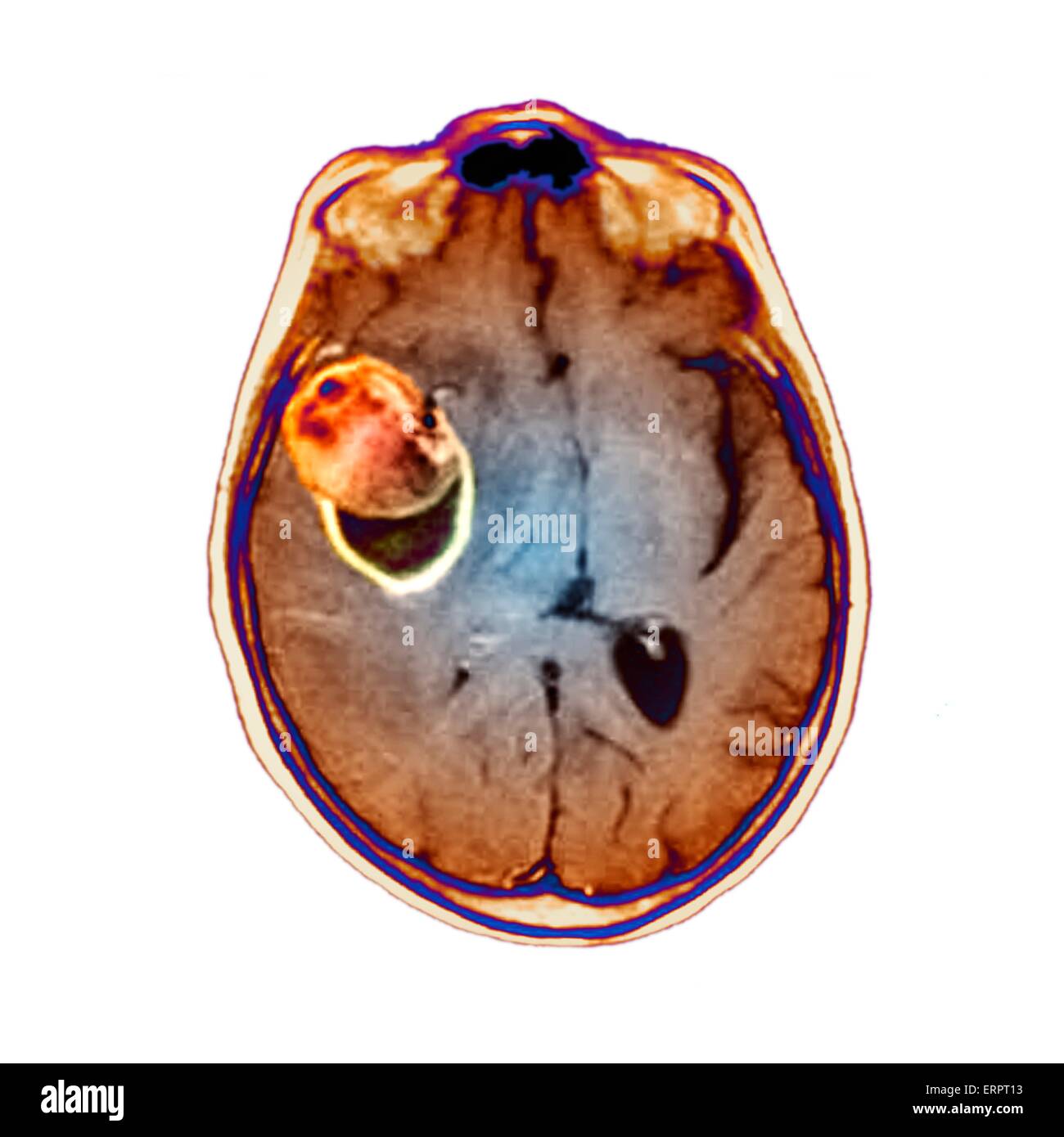 Colorato la tomografia computerizzata (CT) scansione del cervello di un 58 anno vecchio paziente che ha avuto un aneurisma (arancione) in arteria cerebrale media. Un aneurisma è un sangue-riempito la dilatazione in un vaso sanguigno. Essa è causata da un indebolimento della parete del vaso che m Foto Stock