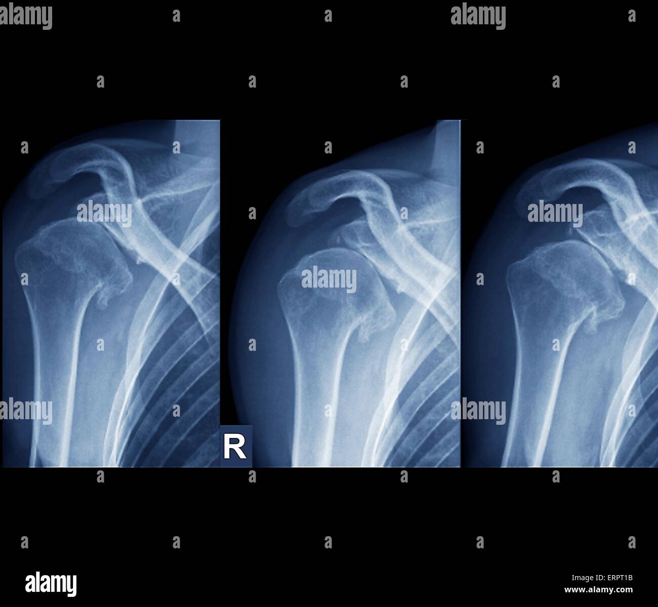 Colorati a raggi X della spalla destra di 36 anno vecchio paziente che ha ripetutamente dislocato il giunto. A sinistra la spalla è in posizione di folle in rotazione a centro in rotazione interna e a destra in rotazione esterna. Le lesioni ripetute hanno causato un BA Foto Stock