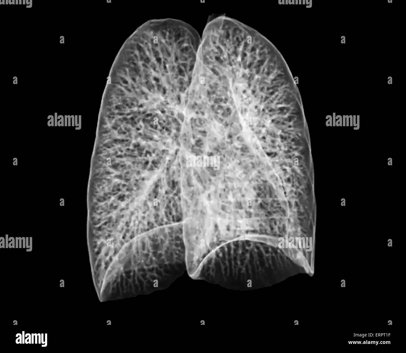 3D la tomografia computerizzata (CT) scansione dei polmoni sani di 30 anno vecchio paziente. Foto Stock