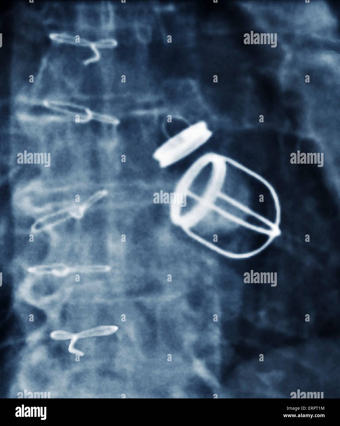 Le valvole cardiache artificiali. Colorati a raggi X del torace di un 59 anno vecchio paziente con insufficienza cardiaca che ha avuto sia la valvola mitrale e le valvole aortiche del loro cuore sostituito con le valvole cardiache artificiali. Foto Stock