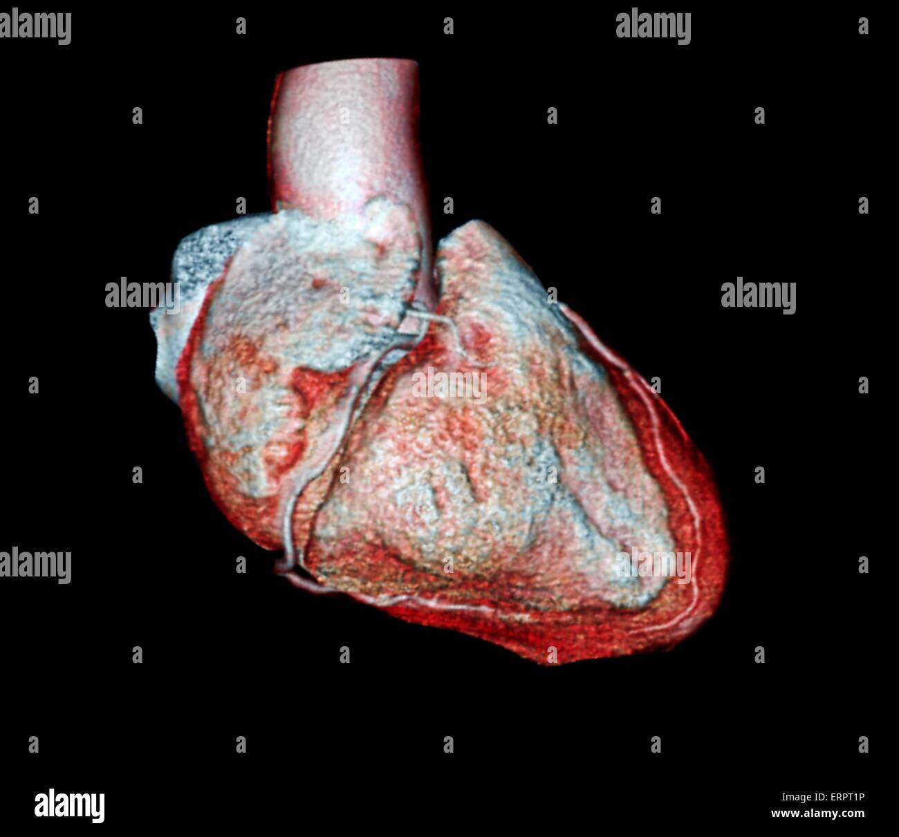 Colorato 3D la tomografia computerizzata (CT) Scansione del cuore di un 54 anno vecchio paziente. La coronaria destra (bianco) è visto dal centro, mentre la sezione anteriore arteria interventricolare (bianco) è visto che corre lungo il bordo di mano destra del cuore. Questo paziente Foto Stock
