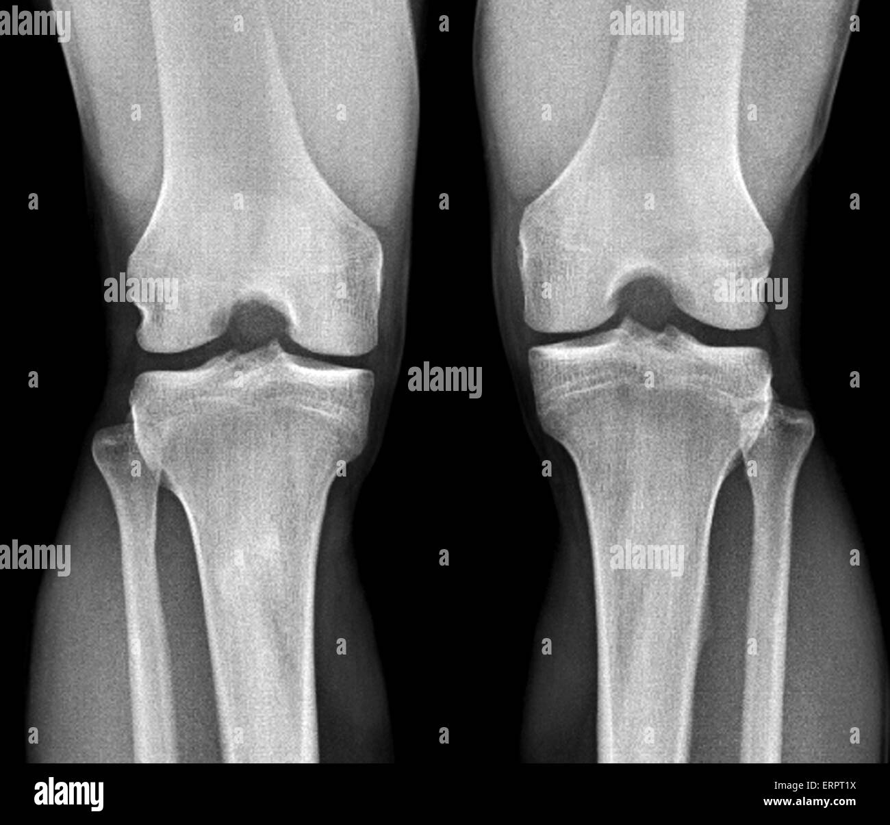 Il normale le ginocchia. Frontale di raggi X di un sano le ginocchia di un 28 anno di età. Foto Stock