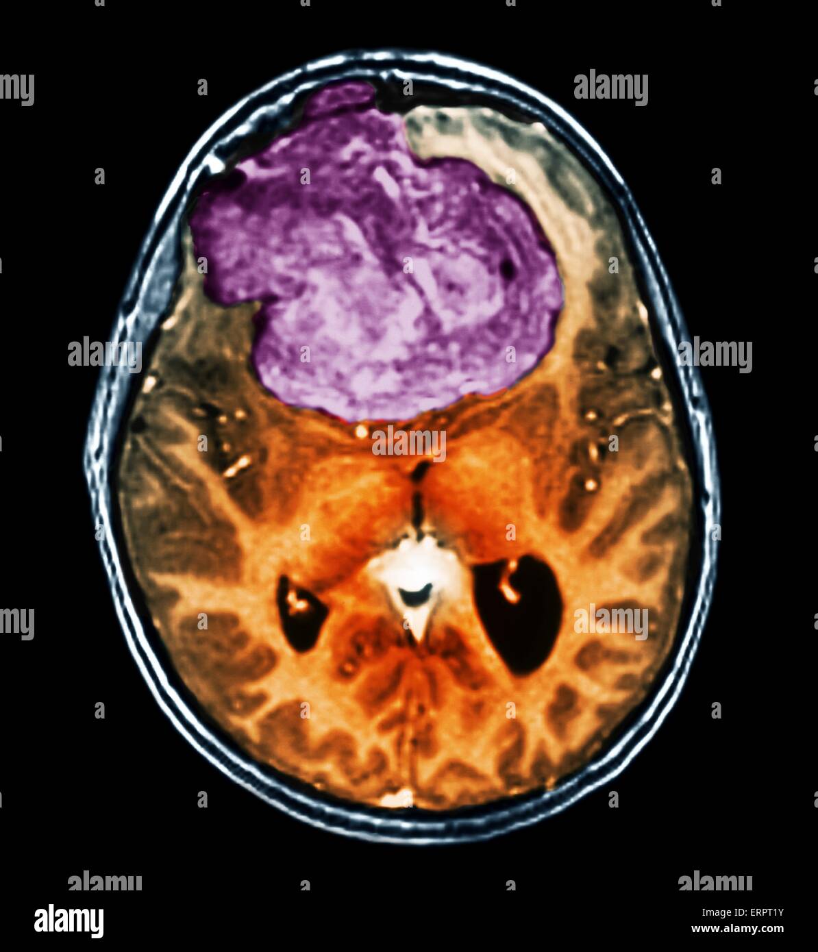 Benigna tumore al cervello. Colorato la tomografia computerizzata (CT) scansione del cervello di un 25 anno di età di un paziente con un meningioma (viola). Si tratta di un benigno (non cancerosi) il tumore che nasce dalla meningi, le membrane che circondano il cervello. È stato causato da ra Foto Stock