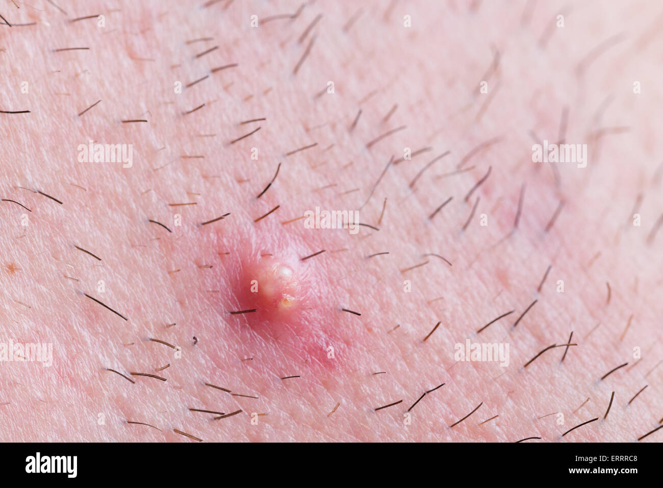 Una ripresa macro di un brufolo su una guancia con un sacco di stoppia. Foto Stock