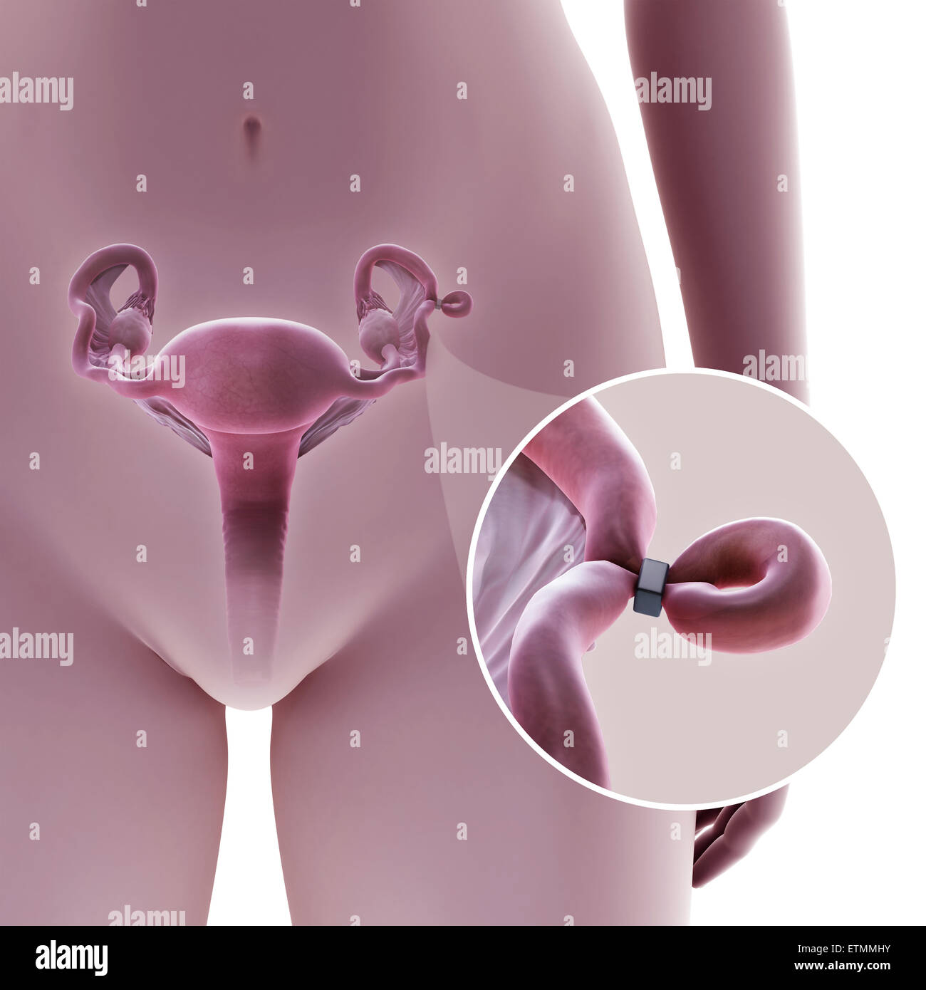 Illustrazione che mostra la legatura delle tube di Falloppio tubo mediante metodo di una banda, utilizzato per bloccare il tubo e impedire la fecondazione. Foto Stock