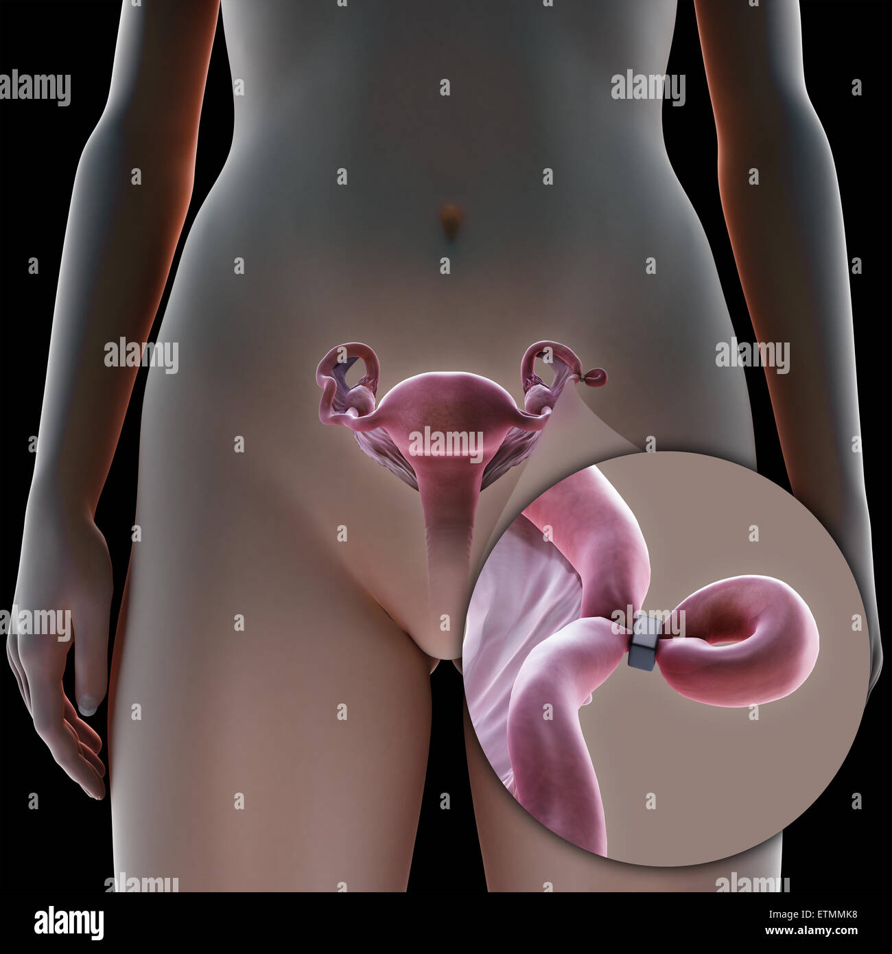 Illustrazione che mostra la legatura delle tube di Falloppio tubo mediante metodo di una banda, utilizzato per bloccare il tubo e impedire la fecondazione. Foto Stock