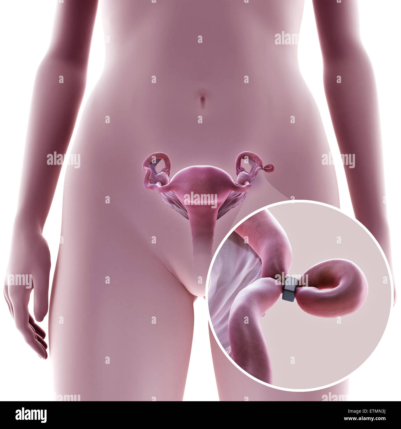 Illustrazione che mostra la legatura delle tube di Falloppio tubo mediante metodo di una banda, utilizzato per bloccare il tubo e impedire la fecondazione. Foto Stock