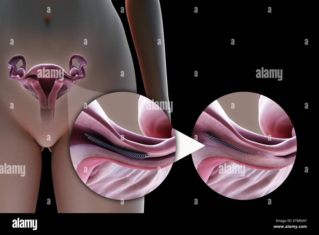 Illustrazione che mostra la legatura delle tube di Falloppio tubo mediante un metodo di un impianto metallico, utilizzato per bloccare il tubo mediante la crescita di tessuto cicatriziale e impedire la fecondazione. Foto Stock