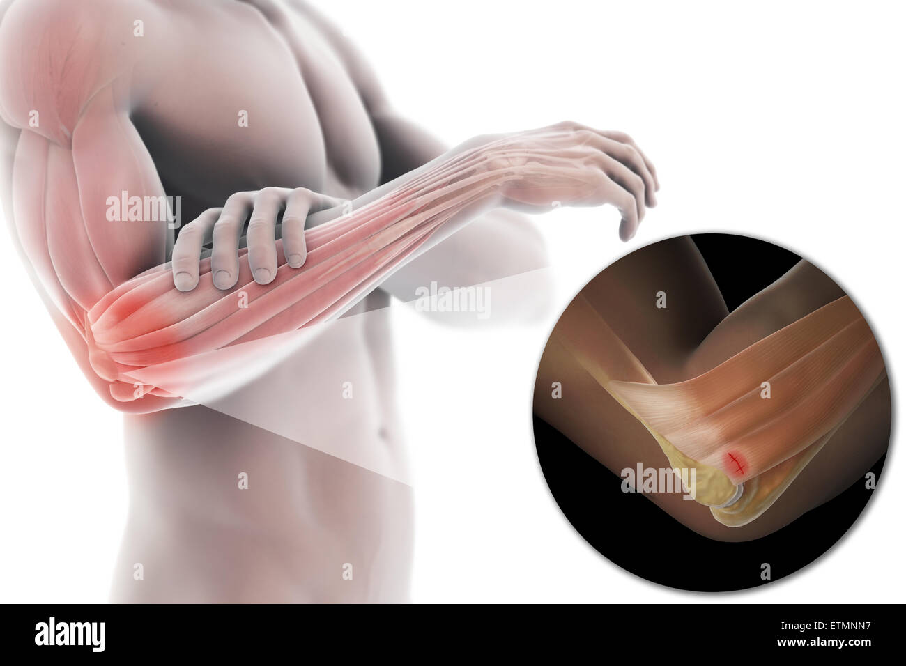 Illustrazione del braccio con la pelle trasparente per mostrare lesioni al laterale tendine epicondyle, noto come epicondilite laterale o il gomito del tennista. Foto Stock