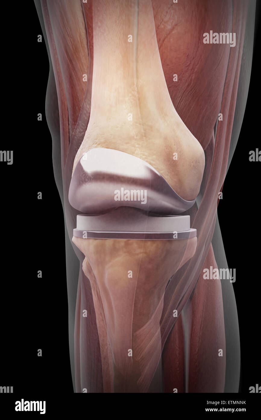Illustrazione che mostra una sostituzione del ginocchio trasparente con il muscolo. Foto Stock