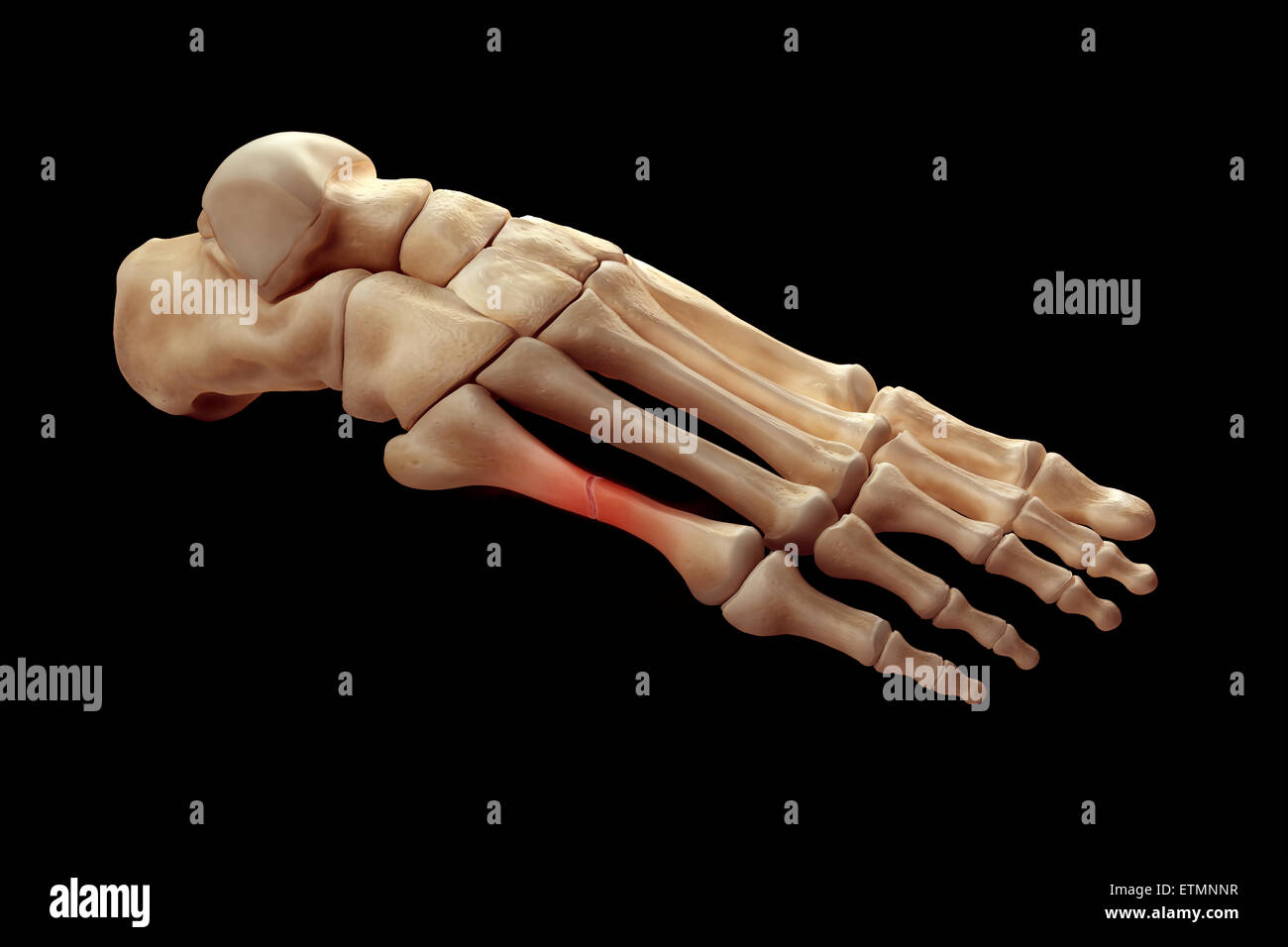 Illustrazione che mostra le ossa del piede con una pausa in un metatarso evidenziata. Foto Stock