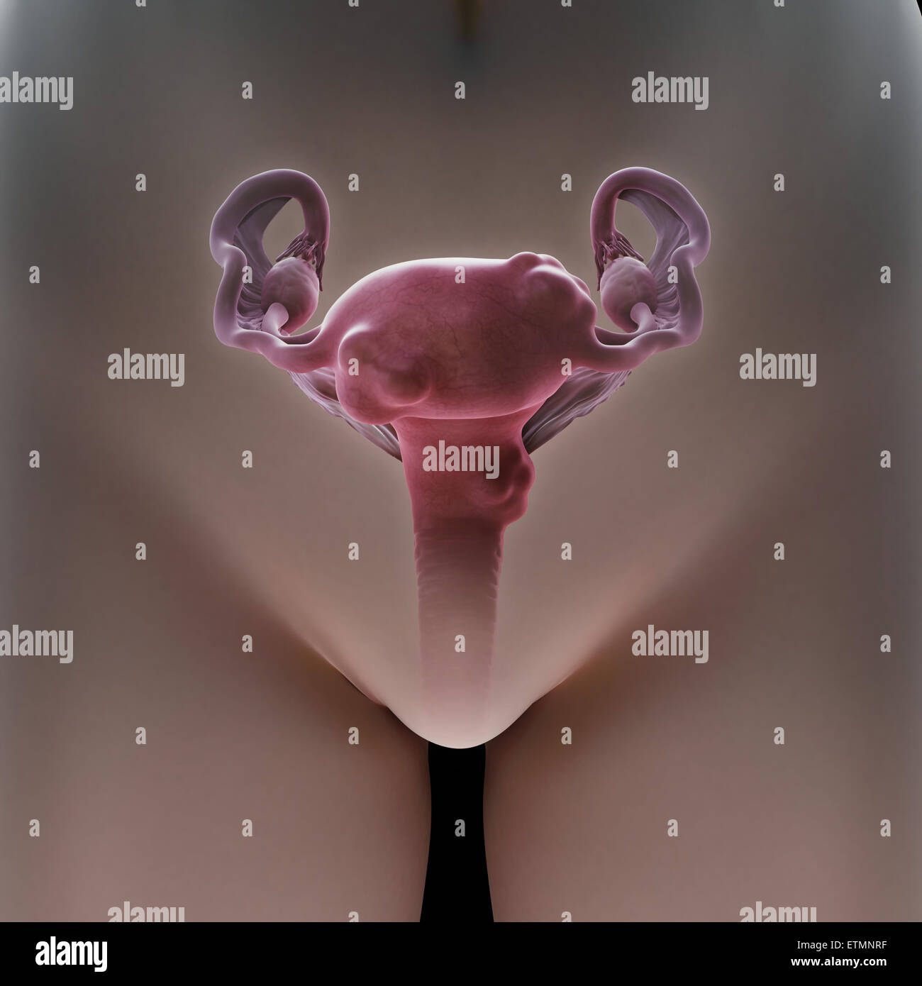 Illustrazione di un grembo afflitto con fibroidi uterini, tumori benigni dell'utero. Foto Stock