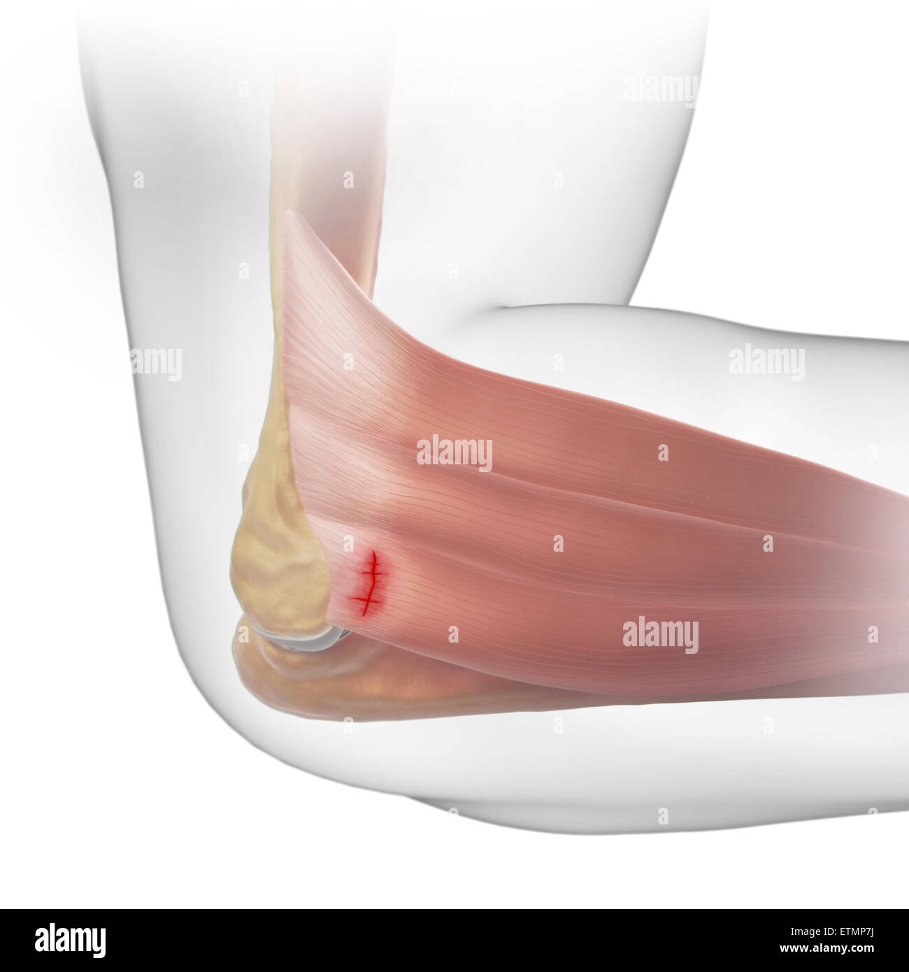 Illustrazione del braccio con la pelle trasparente per mostrare lesioni al laterale tendine epicondyle, noto come epicondilite laterale o il gomito del tennista. Foto Stock