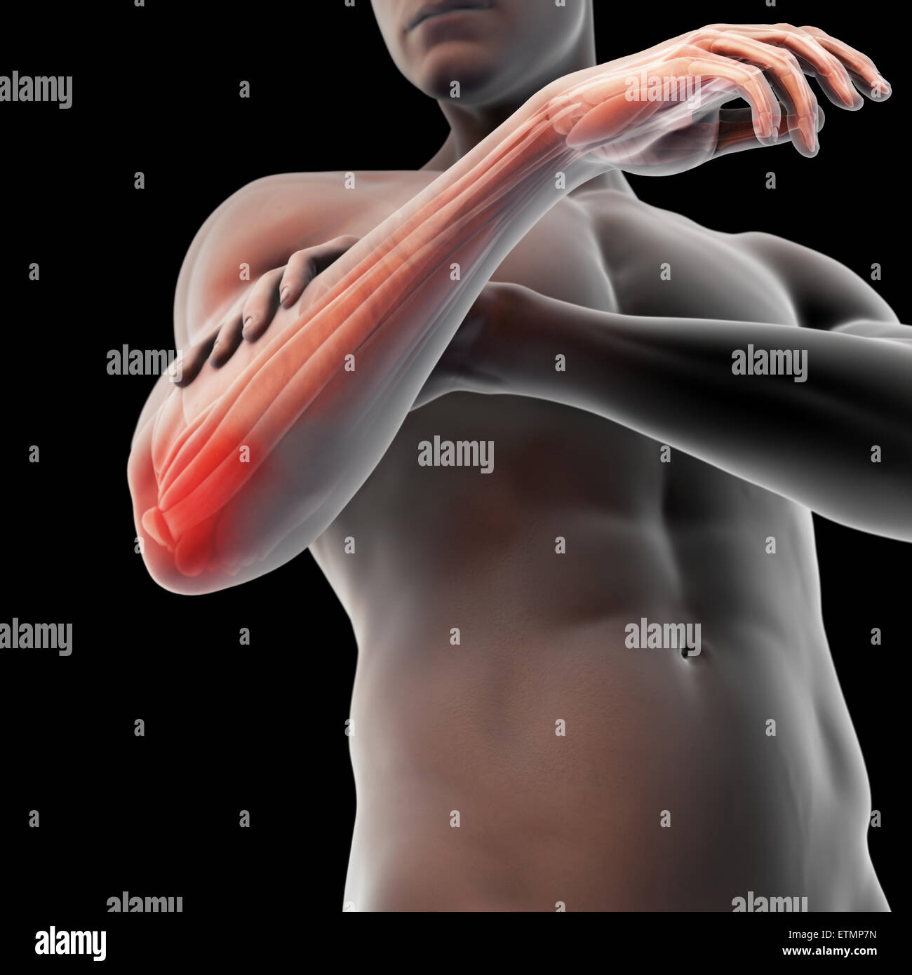 Illustrazione del braccio con la pelle trasparente per mostrare lesioni al laterale tendine epicondyle, noto come epicondilite laterale o il gomito del tennista. Foto Stock