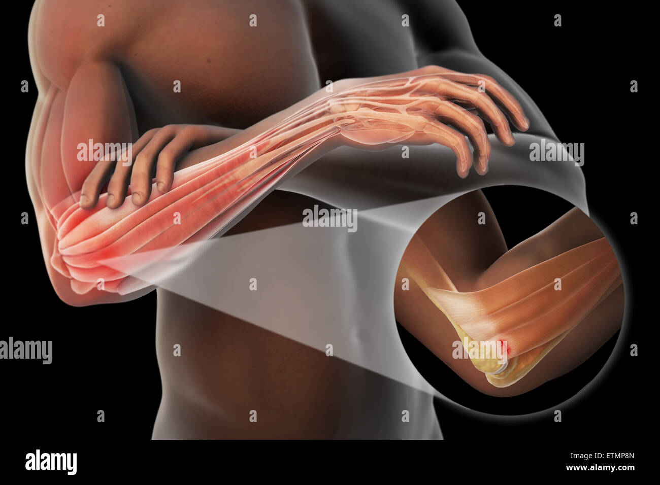 Illustrazione del braccio con la pelle trasparente per mostrare lesioni al laterale tendine epicondyle, noto come epicondilite laterale o il gomito del tennista. Foto Stock