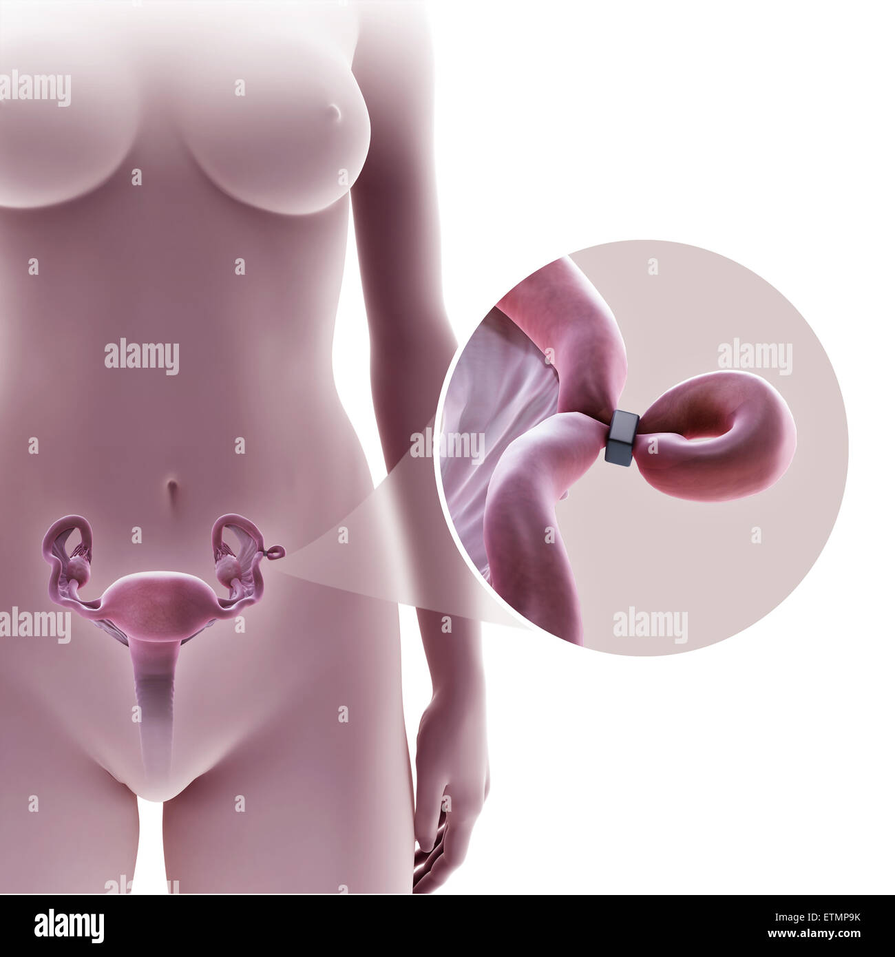 Illustrazione che mostra la legatura delle tube di Falloppio tubo mediante metodo di una banda, utilizzato per bloccare il tubo e impedire la fecondazione. Foto Stock