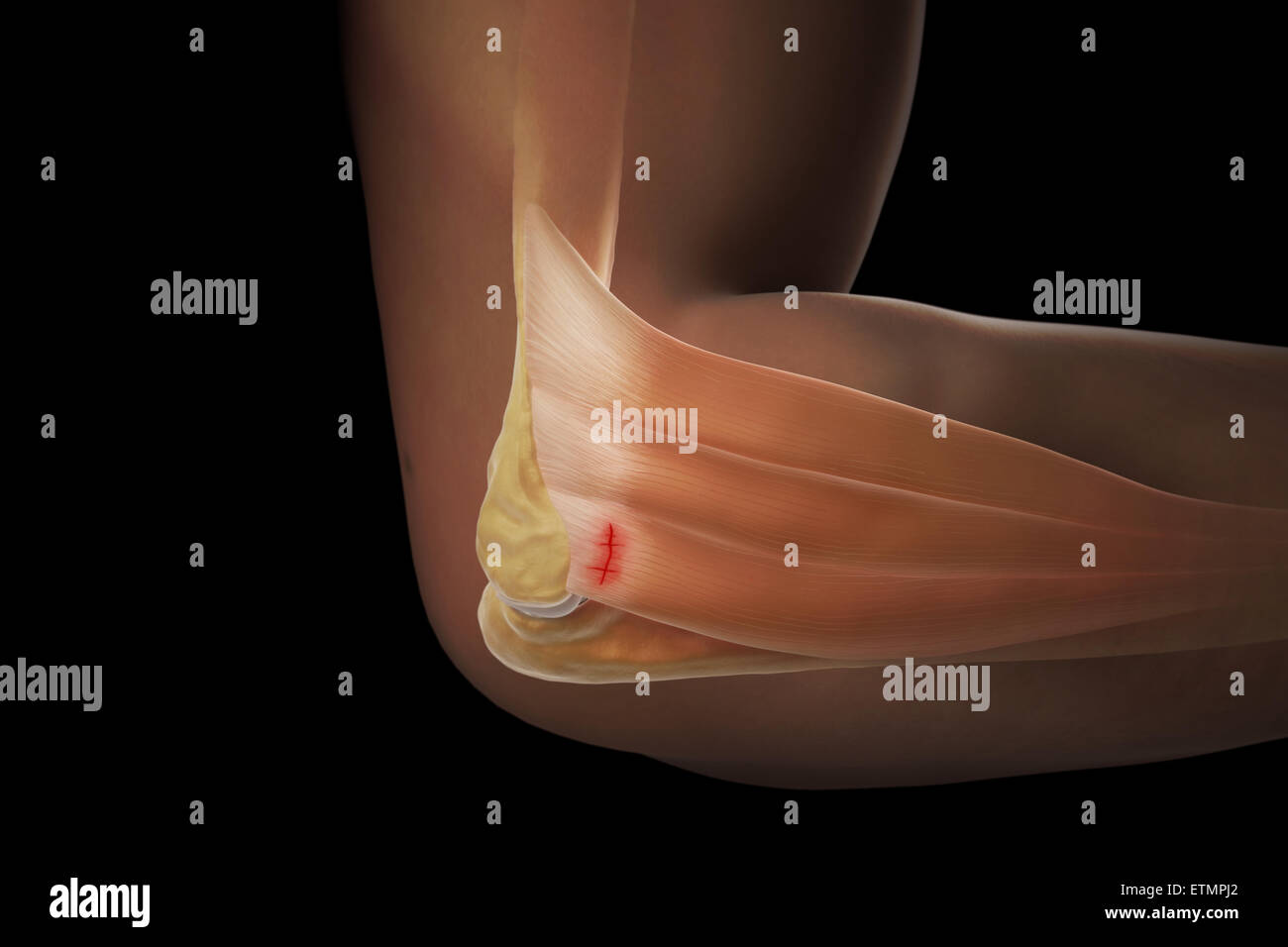 Illustrazione del braccio con la pelle trasparente per mostrare lesioni al laterale tendine epicondyle, noto come epicondilite laterale o il gomito del tennista. Foto Stock