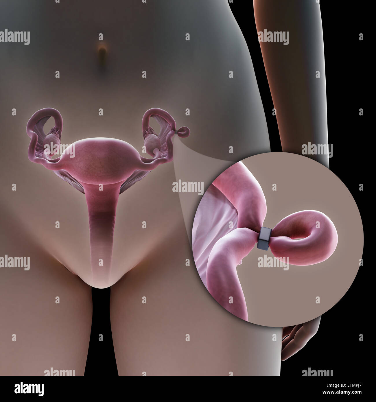 Illustrazione che mostra la legatura delle tube di Falloppio tubo mediante metodo di una banda, utilizzato per bloccare il tubo e impedire la fecondazione. Foto Stock