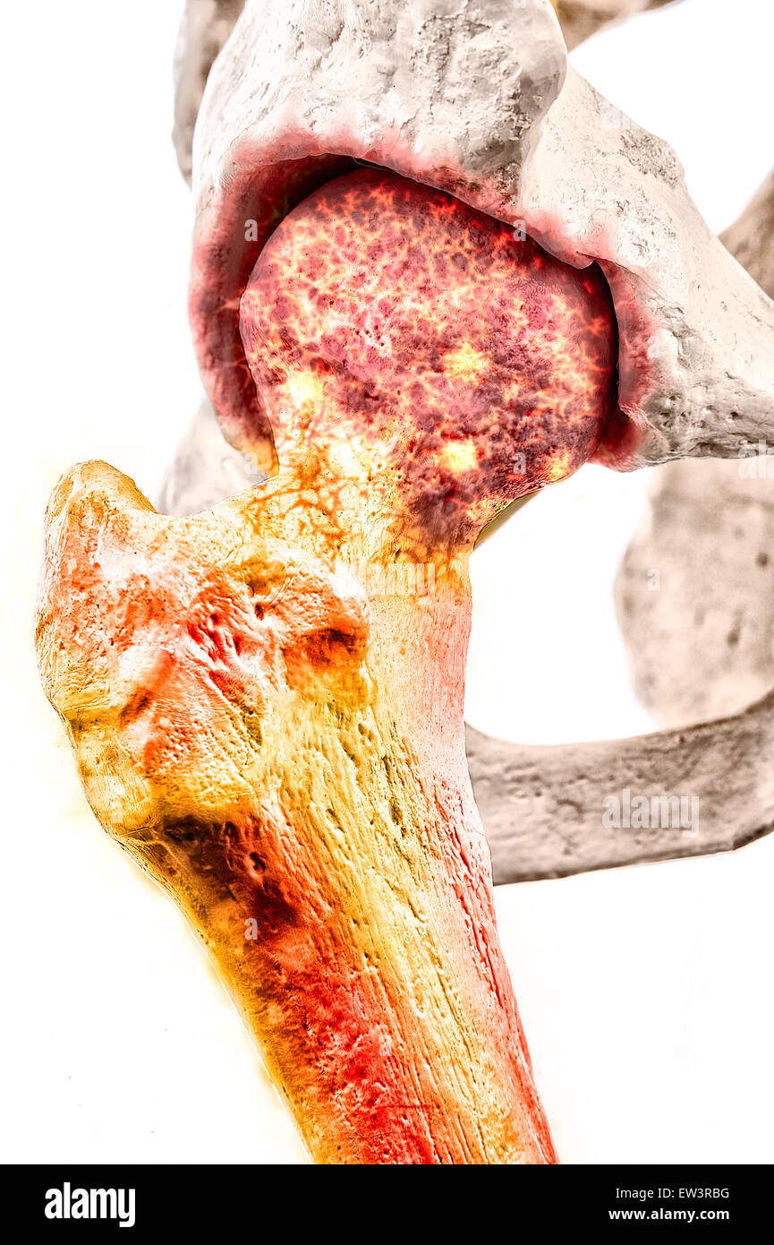 Grafico illustrativo della spondilite anchilosante - una forma degenerativa di artrite che colpisce la colonna vertebrale e articolazioni sacroiliac Foto Stock