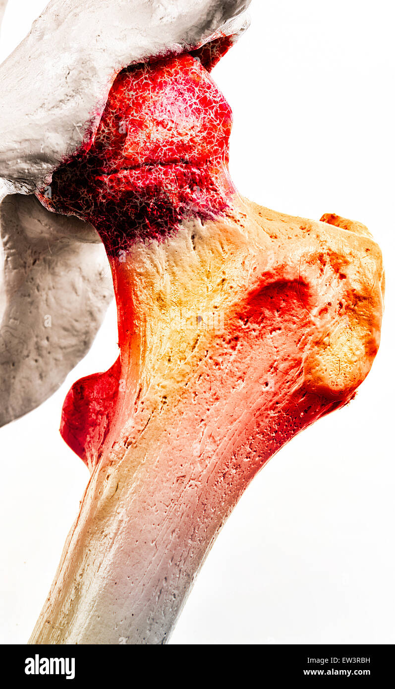 Grafico illustrativo della spondilite anchilosante - una forma degenerativa di artrite che colpisce la colonna vertebrale e articolazioni sacroiliac Foto Stock