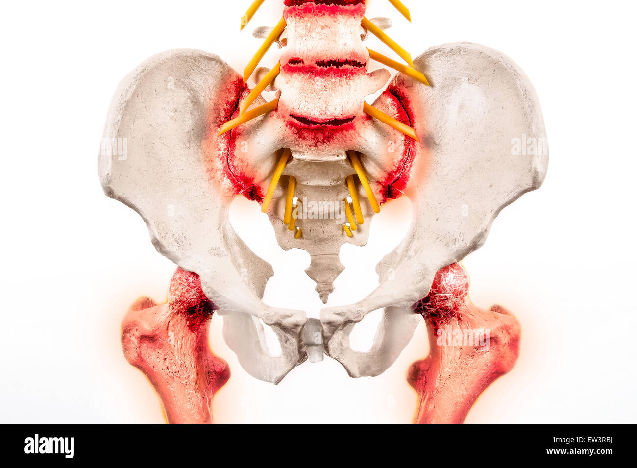 Grafico illustrativo della spondilite anchilosante - una forma degenerativa di artrite che colpiscono il spineand sacroiliac giunti. Foto Stock