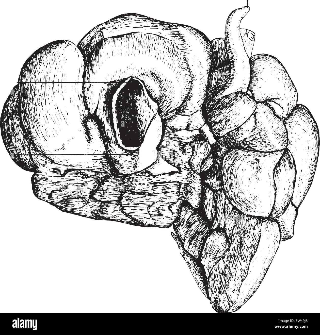 Sotto la superficie del fegato che mostra i risultati di Sifilide congenita, vintage illustrazioni incise. Illustrazione Vettoriale