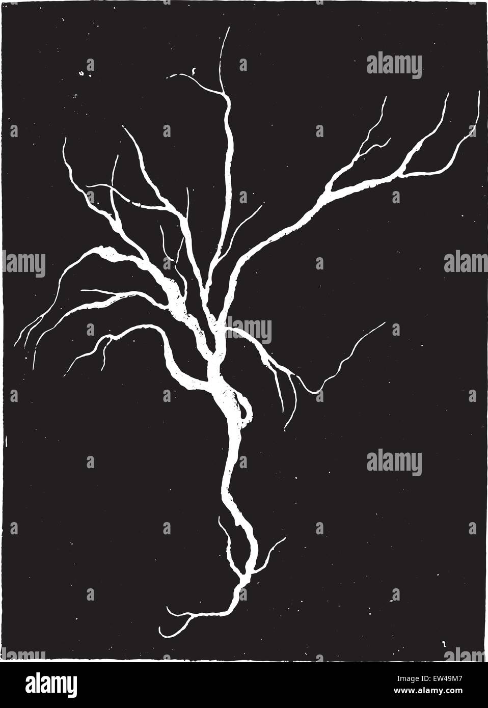 Fibrinosa colato da bronchi, caso di polmonite croupous, vintage illustrazioni incise. Illustrazione Vettoriale