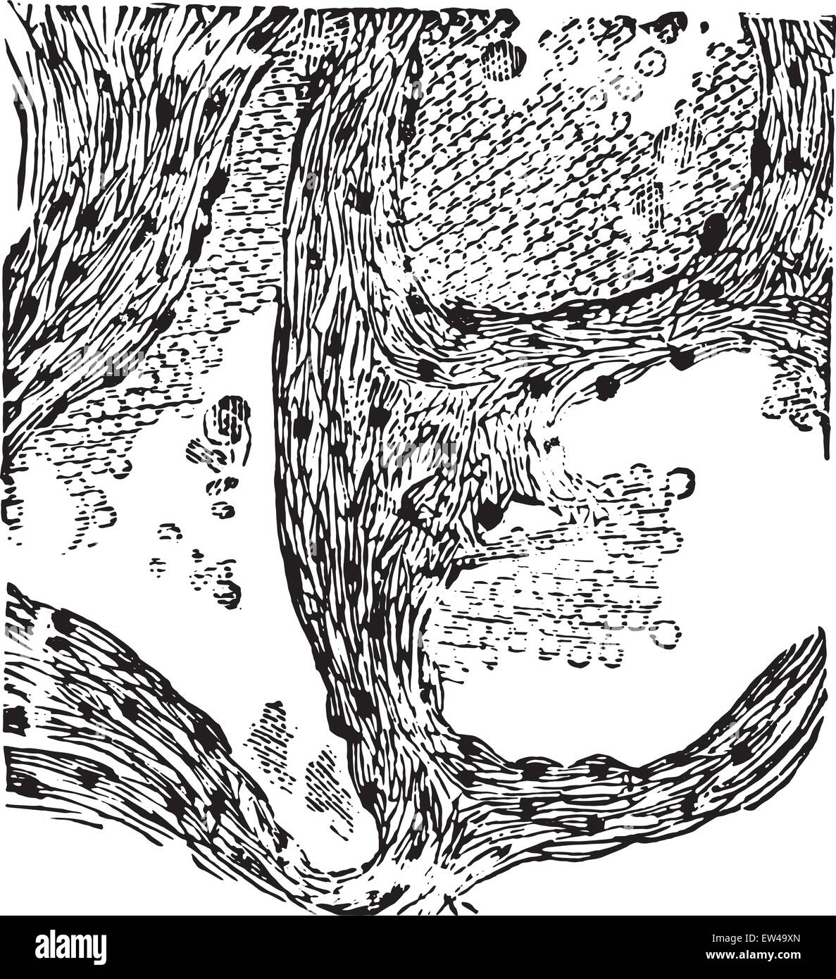 Emangioma cavernoso, vintage illustrazioni incise. Illustrazione Vettoriale Emangioma cavernoso, vintage illustrazioni incise. Illustrazione Vettoriale