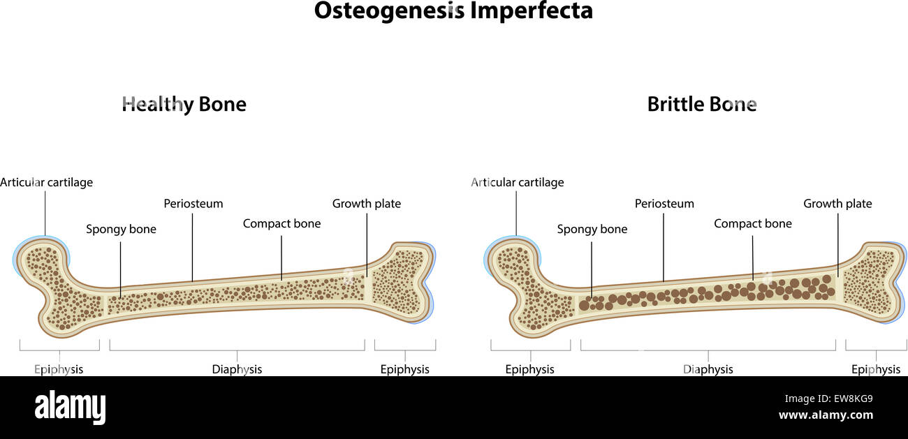 Osteogenesi imperfetta Foto Stock