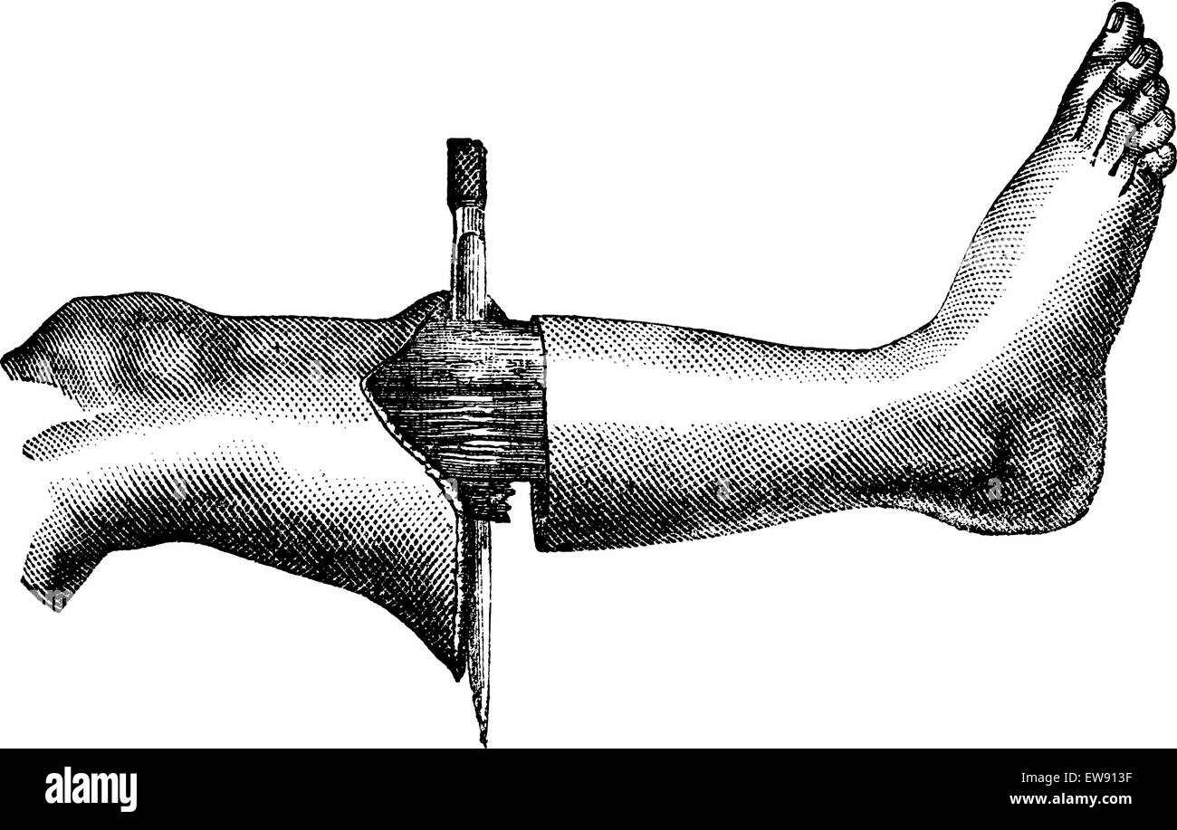 L amputazione della gamba con il metodo presenta due lembi (incisione circolare e la formazione del primo lembo), vintage illustr inciso Illustrazione Vettoriale